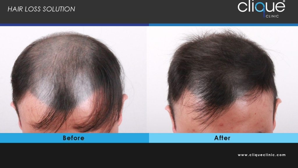 hair loss1