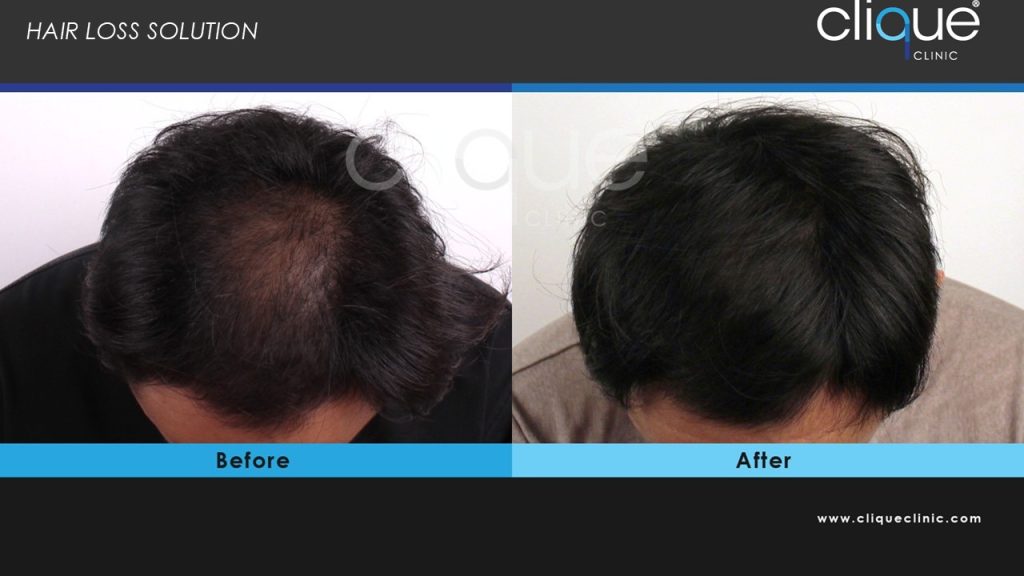 hair loss2