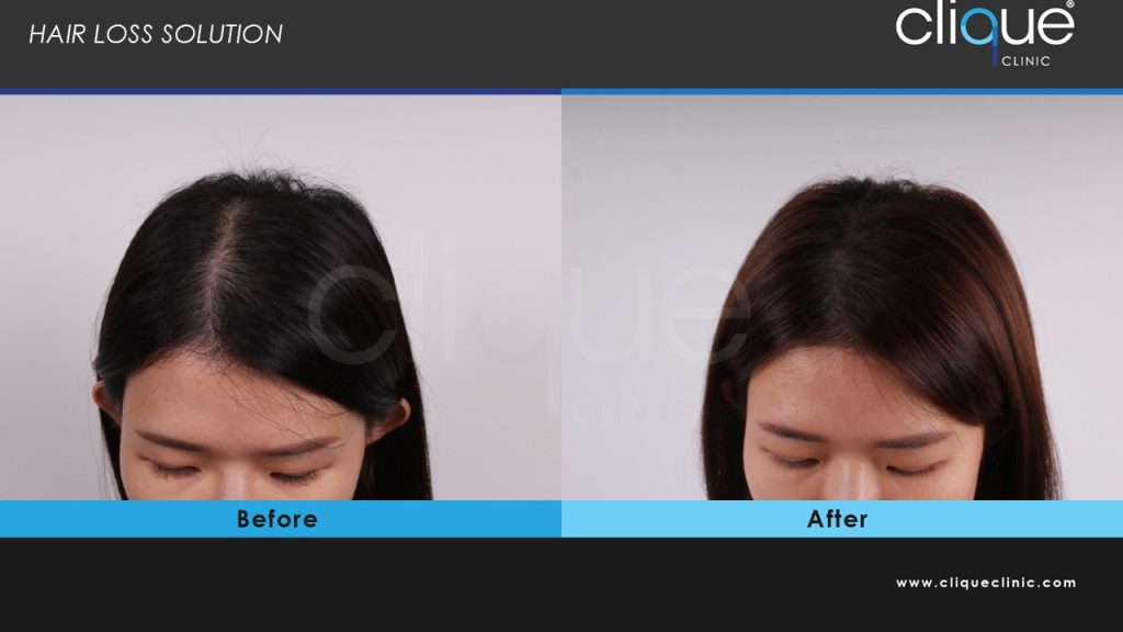 hair loss3