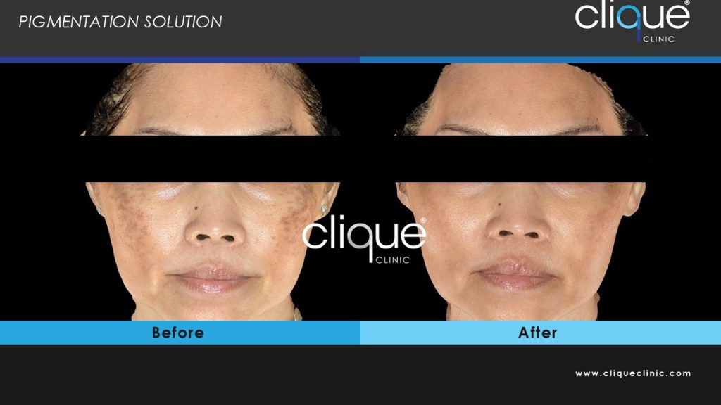 melasma1