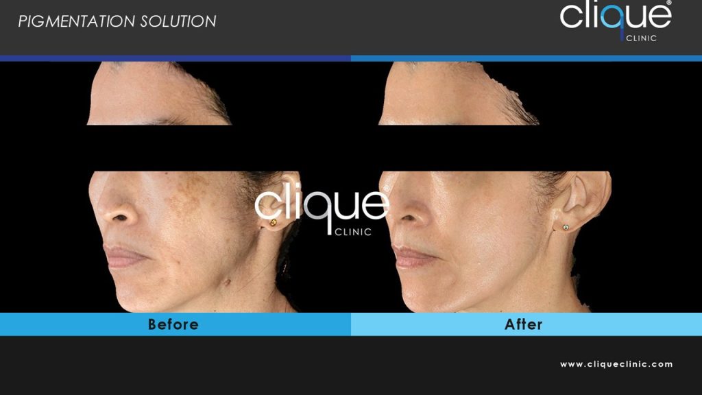 melasma2