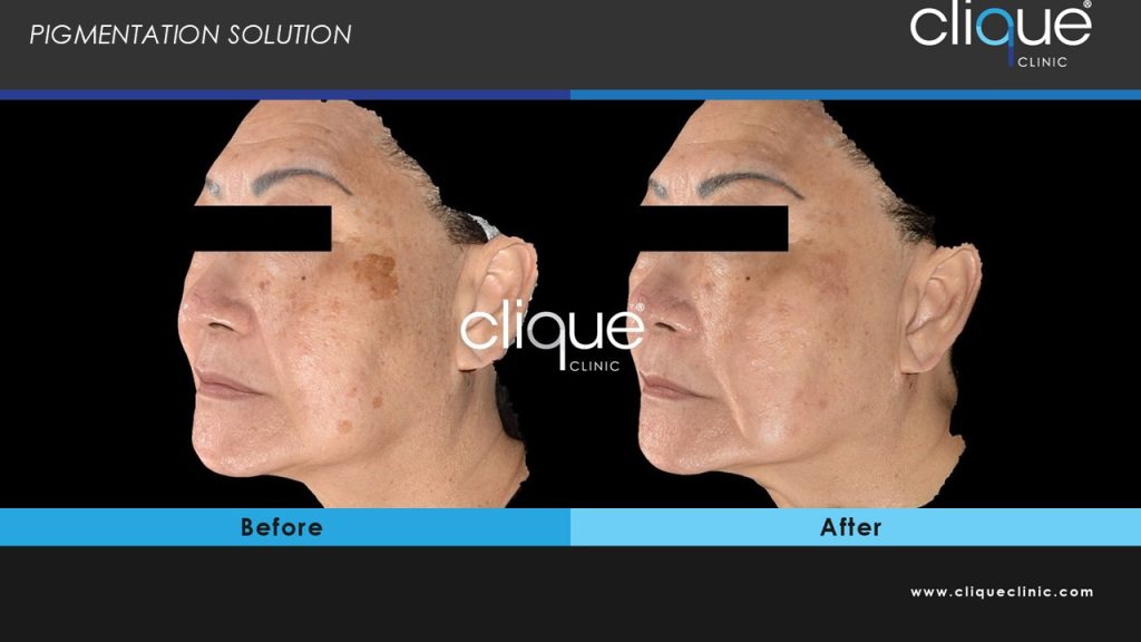 melasma3