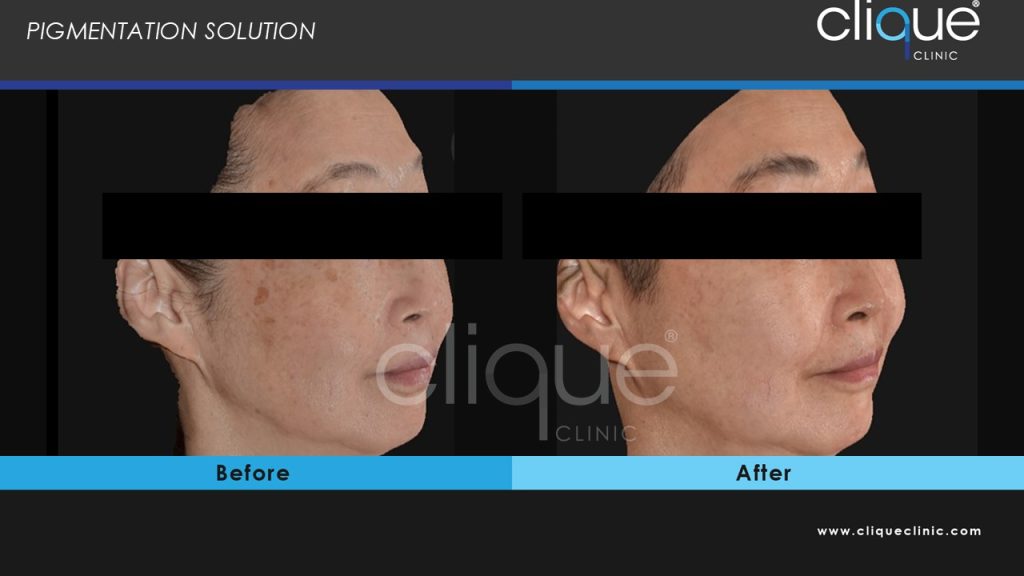 melasma4